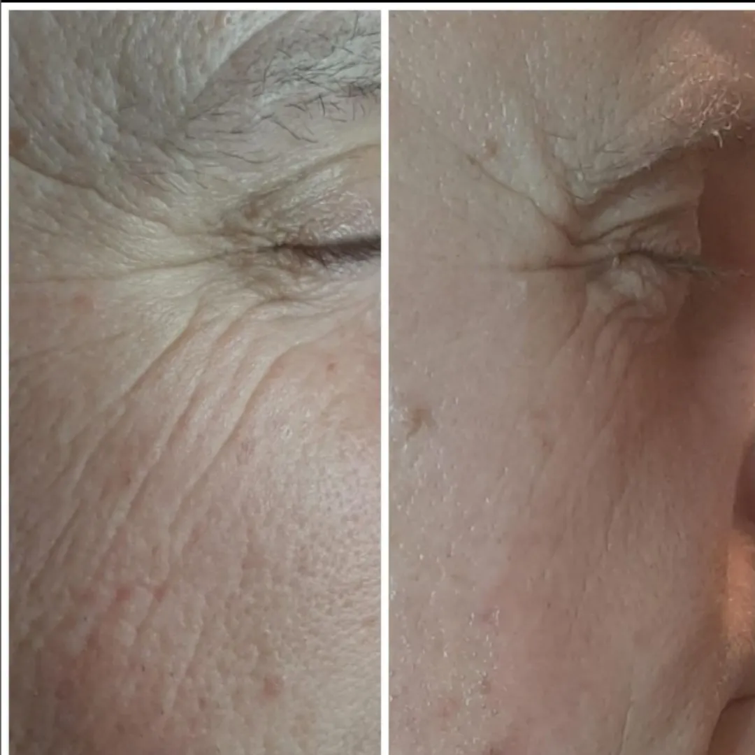 Rejuva Fresh Pro-Secret Icy Gold RF Microneedling Machine