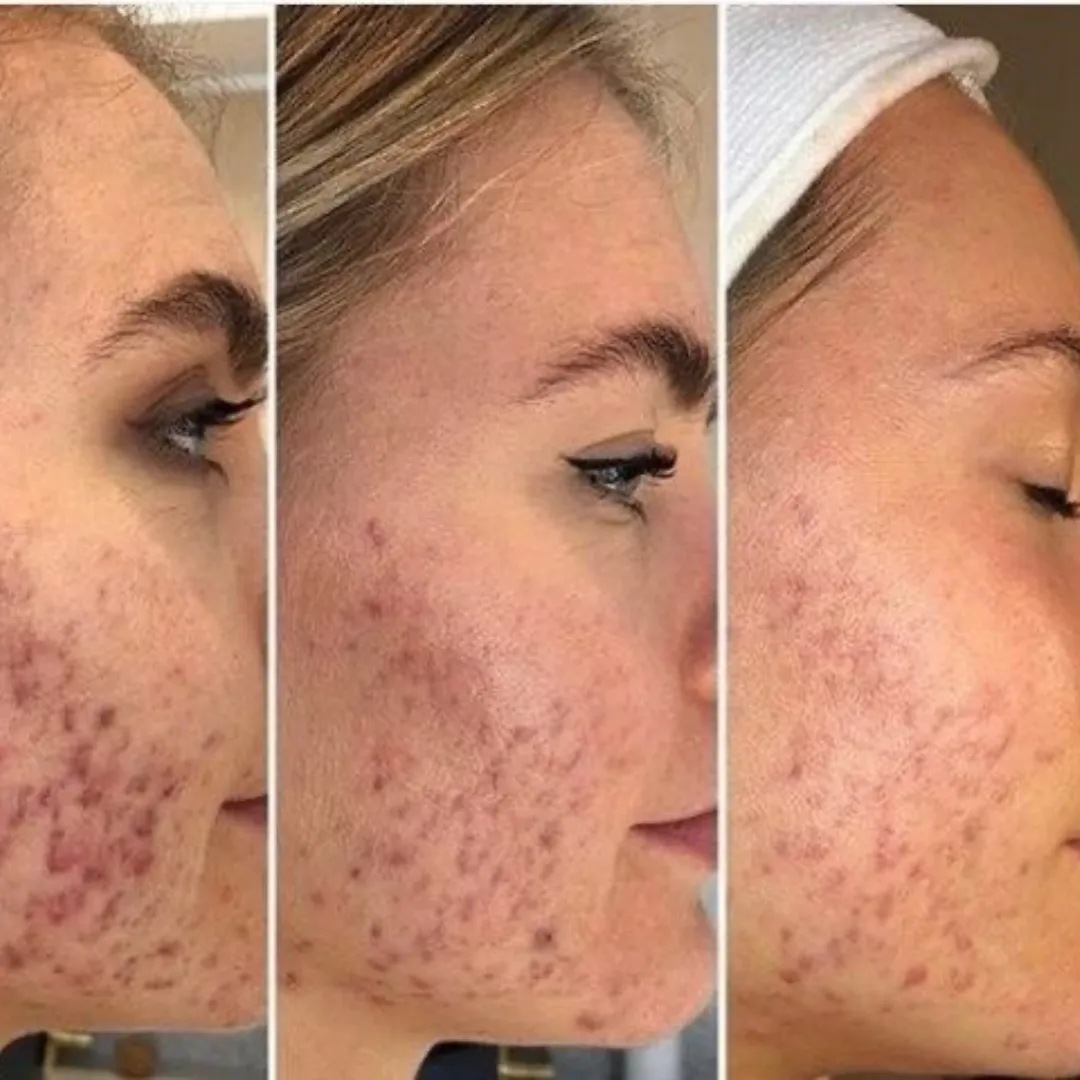 Rejuva Fresh Pro-Secret Icy Gold RF Microneedling Machine